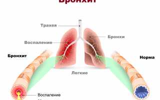 Бронхит у взрослых: причины, симптомы, методы лечения