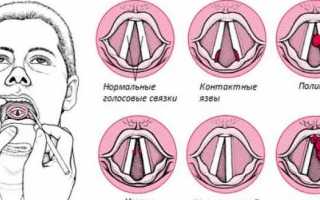 Причины воспаления голосовых связок