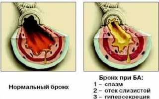 Симптомы и лечение аллергической астмы