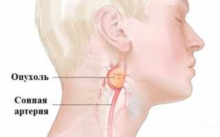Причины опухоли на шее