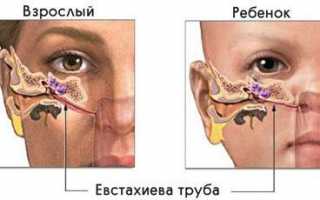 Симптомы и лечение евстахиита