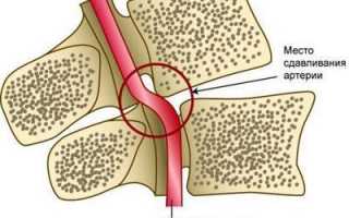 Шумовые эффекты при остеохондрозе шейного отдела: насколько опасно и как бороться