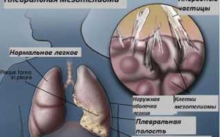 Мезотелиома: особенности опухоли и прогноз