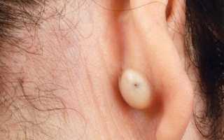 Причины и лечение шишки в ухе
