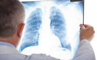 Видно ли на флюорографии рак лёгких