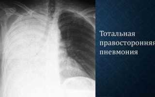 Опасность пневмонии и можно ли от неё умереть