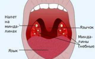 Симптомы и лечение тонзиллофарингита