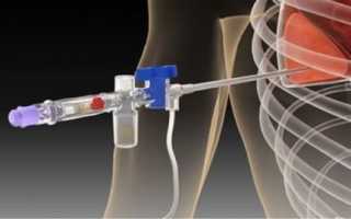 Проведение биопсии лёгких: определение, показания, техника