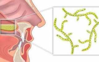 Симптомы и лечение грибкового гайморита