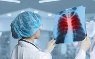 Профилактические меры по предупреждению туберкулёза лёгких