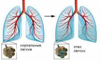 Скопление жидкости в лёгких при онкологии: признаки и терапия