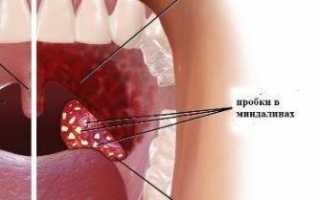 Дыры в миндалинах: причины, симптомы и лечение