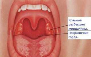 Как лечить горло кормящей маме: обзор безопасных средств