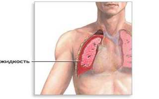 Симптомы и лечение гидроторакса лёгких