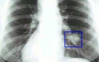 Особенности проведения лобэктомии лёгкого