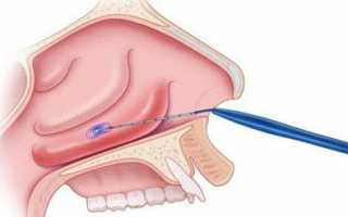 Показания к проведению вазотомии носовых раковин
