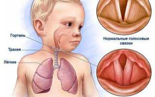 Ларингит у детей: лечение по методике доктора Комаровского