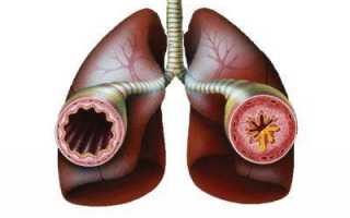 Как купировать приступ астмы в домашних условиях