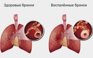 Причины хрипов в лёгких без температуры и с кашлем