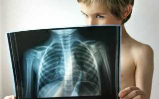 Какие осложнения может дать пневмония у детей