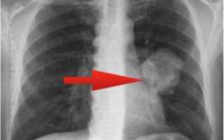 Причины затемнения лёгких на рентген-снимке