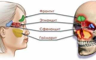 Чем отличается гайморит от синусита