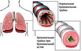 Возможные последствия бронхиальной астмы