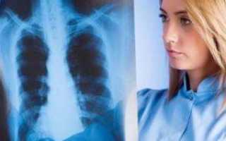 Симптомы и лечение инфильтративного туберкулёза лёгких