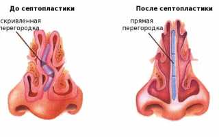 Септопластика носа: показания, противопоказания, нюансы