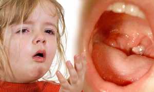 Появление аденоидов у детей: причины и возможные осложнения