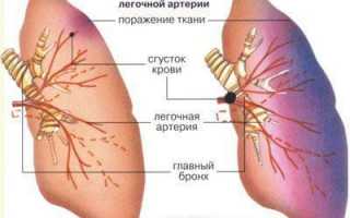 Причины тромбоэмболии лёгочной артерии и её основные характеристики