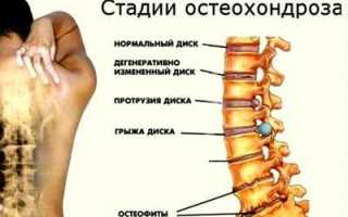 Кашель при остеохондрозе позвоночника