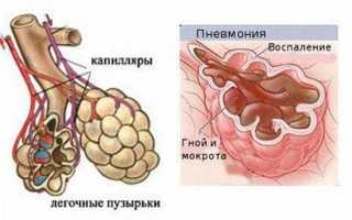 Диетическое питание при пневмонии