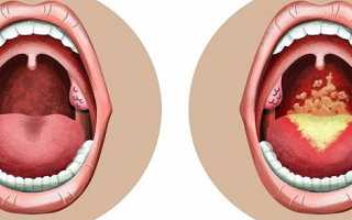Виды и подход к лечению распространённых заболеваний горла
