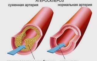 Признаки и лечение застойных явлений в лёгких