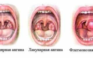 Применение Флемоксина Солютаб при ангине