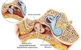 Симптомы и лечение холестеатомы уха