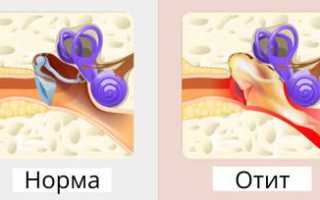 Симптомы и лечение отита среднего уха