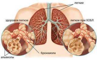 Хроническая обструктивная болезнь лёгких и всё, что необходимо о ней знать