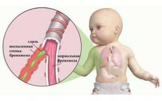 Особенности лечения бронхита у грудничков