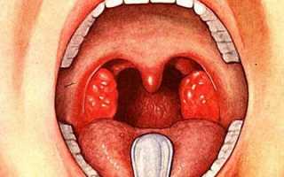 Симптомы и лечение бактериального фарингита