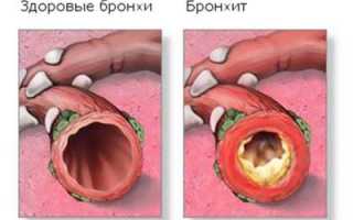 Причины и лечение рецидивирующего бронхита