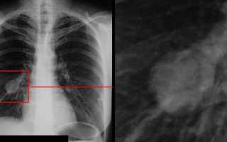 Признаки рака лёгких на рентгене