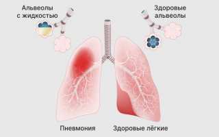 Симптомы и лечение пневмонии у взрослых