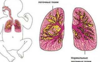 Бронхолёгочная дисплазия: причины, симптомы, диагностика и лечение у детей