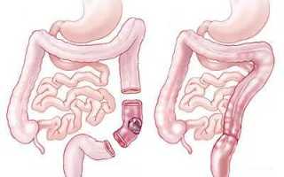 Поможет ли операция при раке сигмовидной кишки?