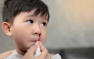 Причины носового кровотечения у ребёнка