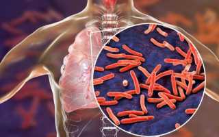 Как избежать заражения туберкулёзом – эффективные защитные меры