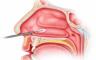 Заболевания носовых раковин и методы их лечения