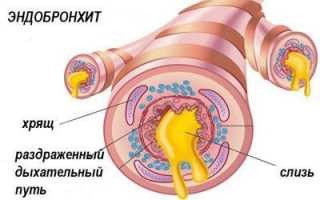 Особенности эндобронхита и его лечение